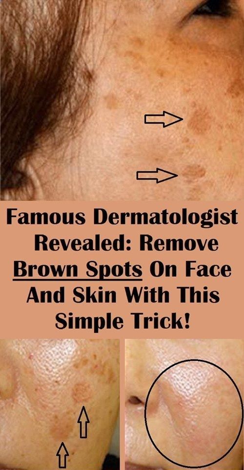 Famous Dermatologist Revealed: Remove Brown Spots On Face And Skin With This Simple Trick!