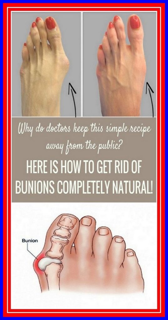 WHY DO DOCTORS KEEP THIS SIMPLE RECIPE AWAY FROM THE PUBLIC? HERE’S HOW TO GET RID OF BUNIONS COMPLETELY NATURAL HEALTH