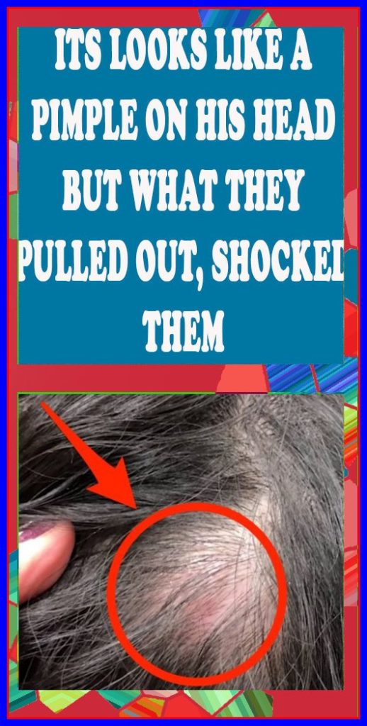It Looks Like A Pimple On His Head, But What They Pulled Out Shocked Them