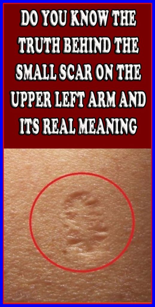 Do You Know The Truth Behind The Small Scar On The Upper Left Arm And Its Real Meaning
