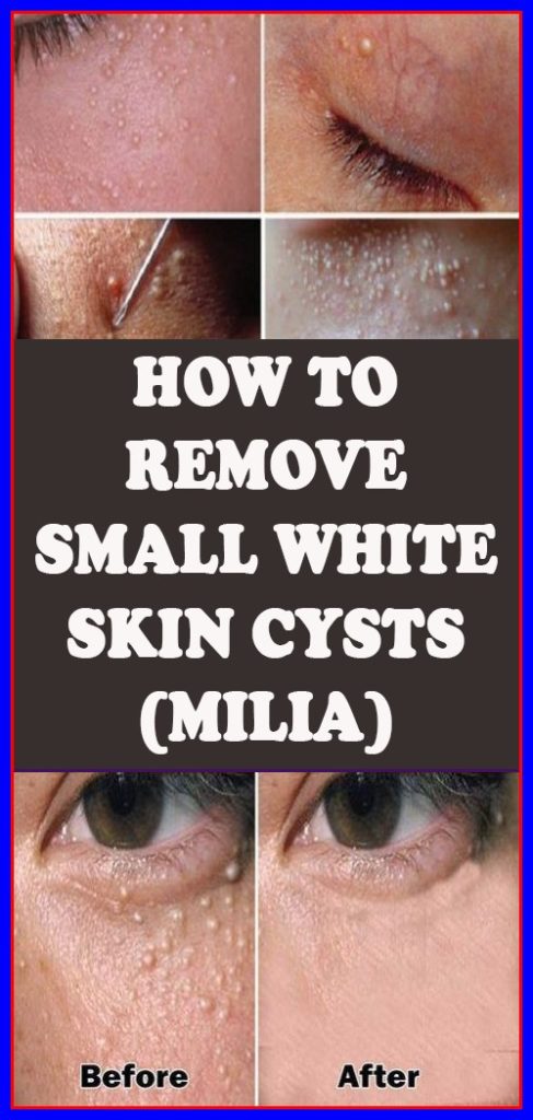MILIA: HOW TO REMOVE THE SMALL WHITE SKIN CYSTS?