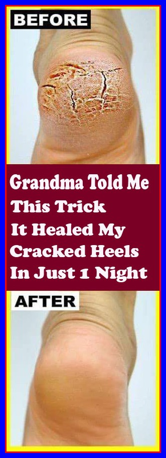 GRANDMA TOLD ME THIS TRICK. IT HEALED MY CRACKED HEELS IN JUST 1 NIGHT!!!