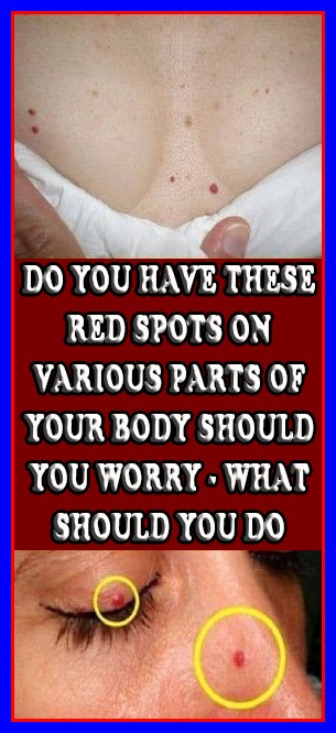 Do You Have These Red Spots On Various Parts Of Your Body? Should You Worry? What Should You Do?