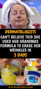 DERMATOLOGISTS CAN T BELIEVE THIS SHE USED HER GRANDMAS FORMULA TO ERASE HER WRINKLES IN 3 DAYS