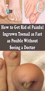 How To Get Rid Of A Painful Ingrain Nail Without a Doctor